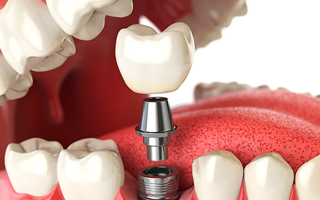 Your Dental Implant Questions Answered