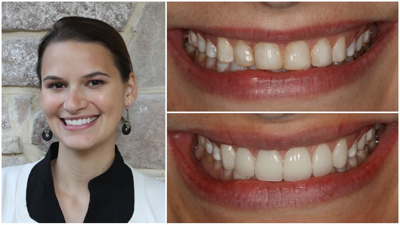 The before and after of the smile of one of our patients
