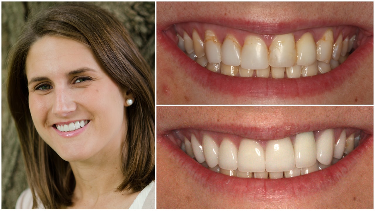The before and after of the smile of patient 1