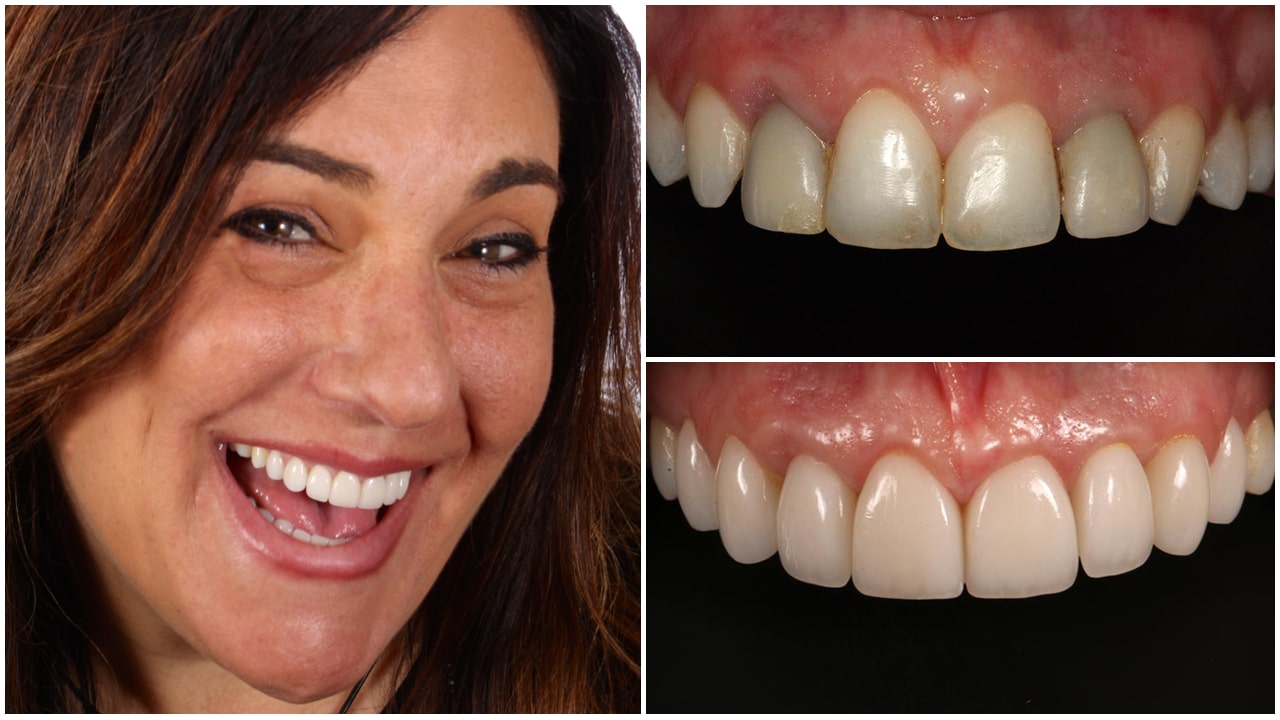The before and after of the smile of patient 2