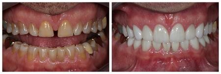 The before and after of the smile of the patient 2