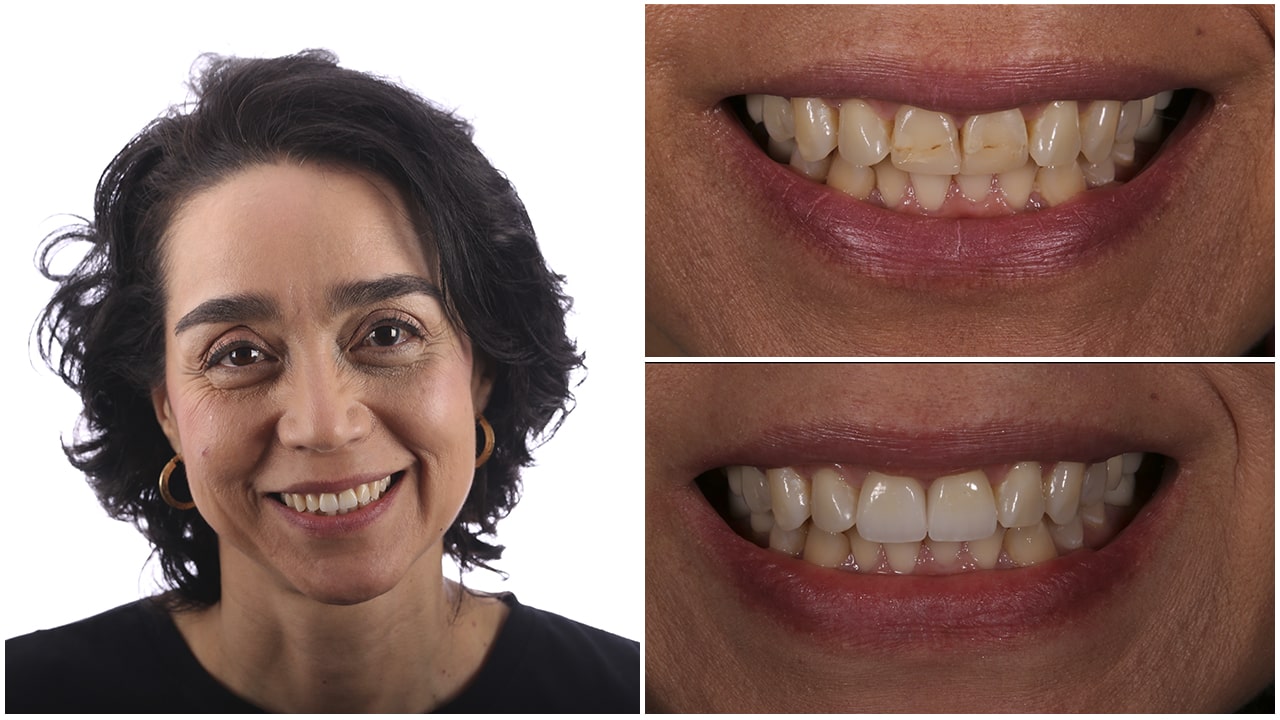 The before and after of the smile of one of our patients